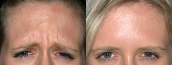23 Year Old Female Preventative Treatment to Frown Lines before 1299464