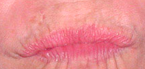 Botox before 1018214