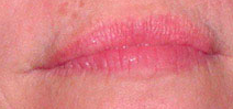 Botox after 1018214