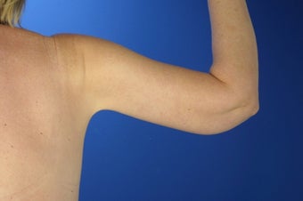 45 Year Old Weight Loss Patient With Arm Laxity 777555