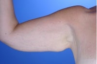 45 Year Old Weight Loss Patient With Arm Laxity before 777555