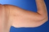 45 Year Old Weight Loss Patient With Arm Laxity 777555