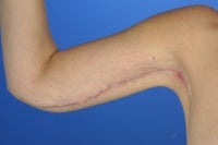 45 Year Old Weight Loss Patient With Arm Laxity after 777555