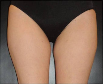 SmartLipo MPX after 686323