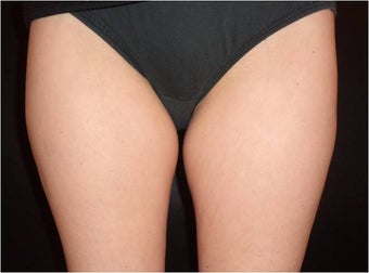 SmartLipo MPX before 686323