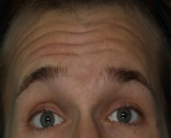 Male treated for Forehead Wrinkles before 772008