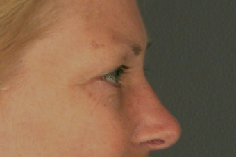 Eyelid Surgery before 310161