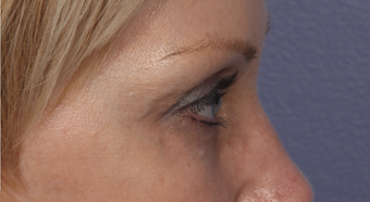 Eyelid Surgery after 310161