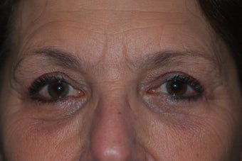 Ptosis Repair with combined Lower Lid Blepharoplasty after 917849
