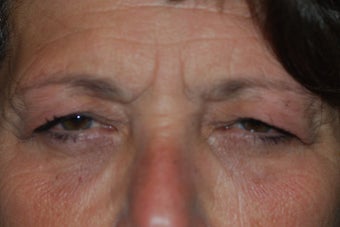 Ptosis Repair with combined Lower Lid Blepharoplasty before 917849
