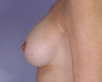 Breast Augmentation after 281416