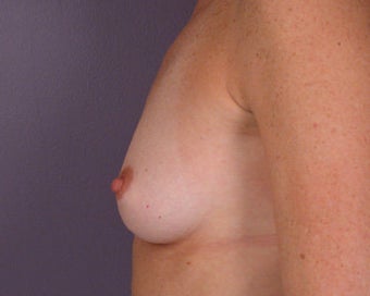 Breast Augmentation before 281416