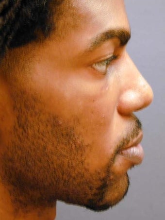 Male Chin Implant after 887049