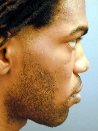 Male Chin Implant before 887049