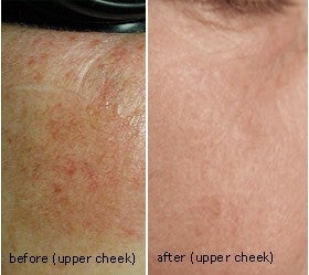 Laser therapy to correct melasma before 6540