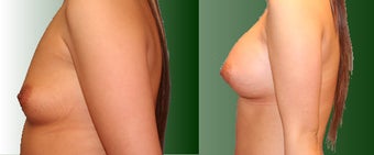 Breast Augmentation before 96466