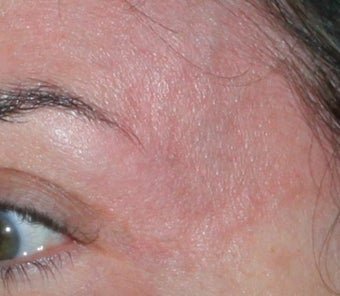 Laser Vein Removal 374359