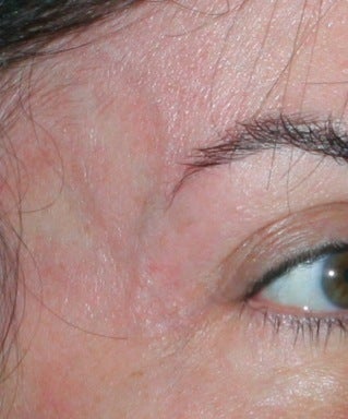 Laser Vein Removal after 374359