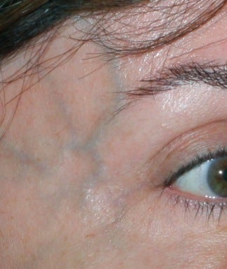 Laser Vein Removal before 374359