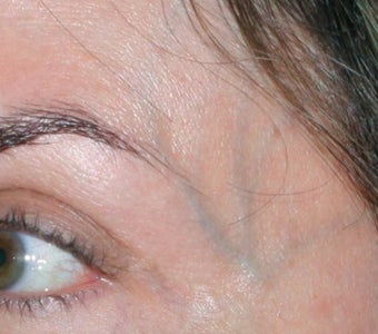 Laser Vein Removal 374359
