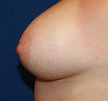 Breast Augmenttion after 572300