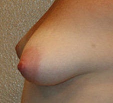 Breast Augmenttion before 572300