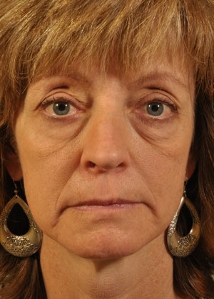 Phenol Peel before 857659