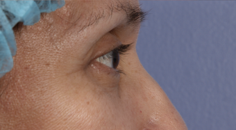 Eyelid Surgery 302506