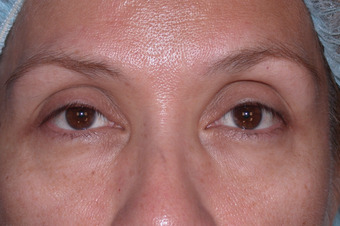 Eyelid Surgery before 302506
