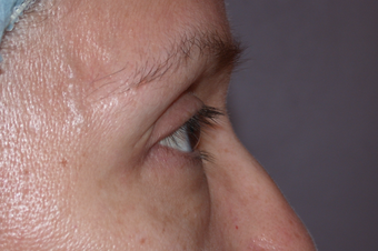 Eyelid Surgery 302506