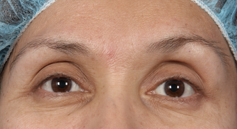 Eyelid Surgery after 302506