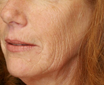 Laser Skin Renewal of Cheek Wrinkles before 1174468