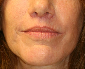 Laser Skin Renewal of Cheek Wrinkles 1174468