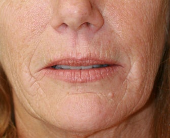 Laser Skin Renewal of Cheek Wrinkles 1174468