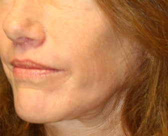 Laser Skin Renewal of Cheek Wrinkles after 1174468