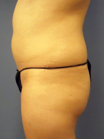 Fat Transfer before 505138