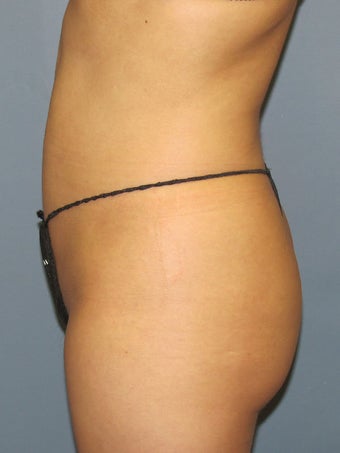 Fat Transfer after 505138