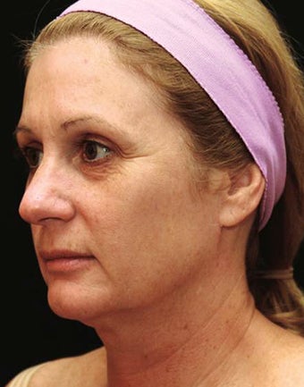 Fraxel Repair for Sun Damage and Tightening before 68015