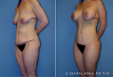 Body Lift before 216782