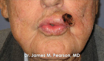 Lip Reconstruction 919806