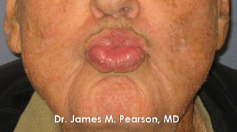 Lip Reconstruction 919806