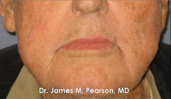 Lip Reconstruction after 919806
