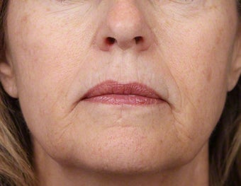 Alex Laser for Age Spots after 539888