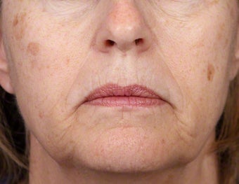 Alex Laser for Age Spots before 539888