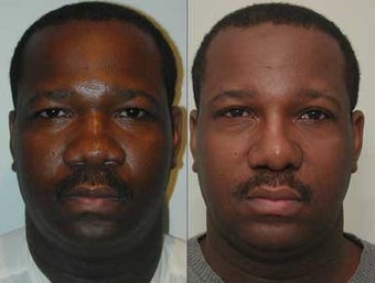 African American Rhinoplasty before 44102