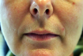 Restylane before 1070411