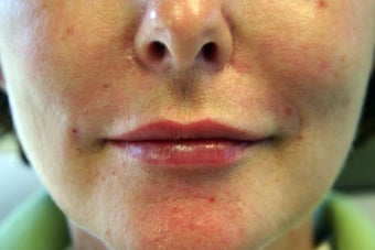 Restylane after 1070411