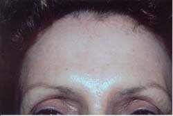 Botox after 611100