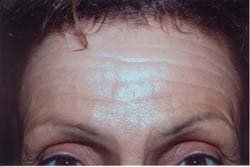 Botox before 611100