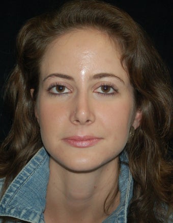 Revision Rhinoplasty after 392825